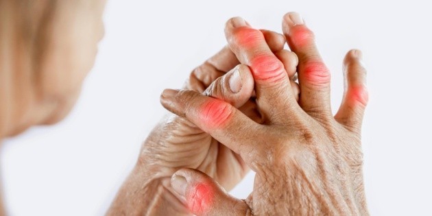 Puntos clave de dolor y rigidez en manos afectadas por osteoartritis. Foto: Especial / CANVA